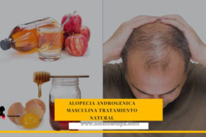 Alopecia androgenetica Masculina : tratamientos naturales